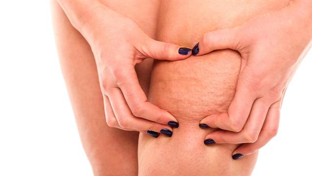 Ποια είναι τα ισχυρότερα “όπλα” κατά της κυτταρίτιδας;