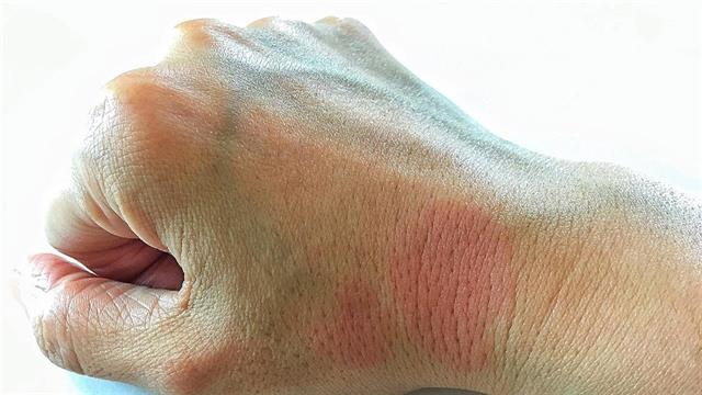 Mετά από 10 χρόνια εγκρίθηκε φάρμακο για τον ερυθηματώδη λύκο