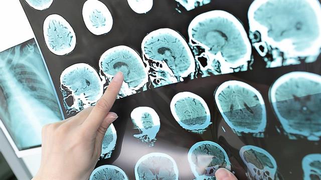 Εκστρατεία ενημέρωσης και ευαισθητοποίησης για την Πολλαπλή Σκλήρυνση