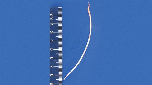 Στα Eπείγοντα με κομμάτι τσιμέντου 10 εκατοστών να του τρυπά την καρδιά