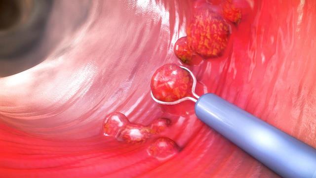 Κολονοσκόπηση για την πρόληψη του καρκίνου του παχέος εντέρου