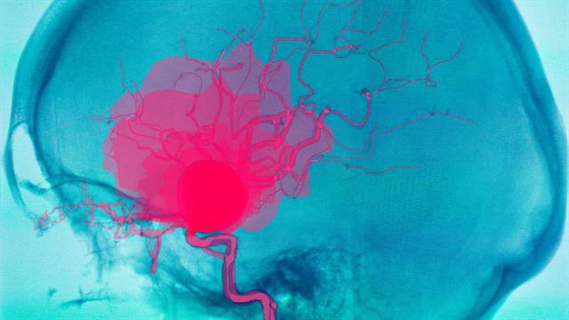 Εγκεφαλικά ανευρύσματα: Σύγχρονες χειρουργικές και ενδαγγειακές τεχνικές