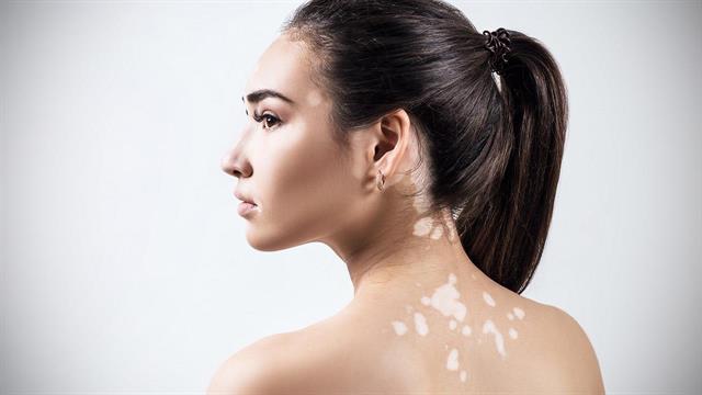 Αποχρωματισμός της επιδερμίδας: Σε ποιες παθήσεις μπορεί να οφείλεται;