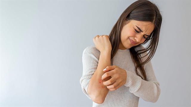 ΄Έκζεμα: Με ποιο τρόπο θα ανακουφιστώ