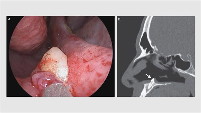 Γιατροί ανακάλυψαν δόντι που αναπτύχθηκε στο ρουθούνι ασθενούς