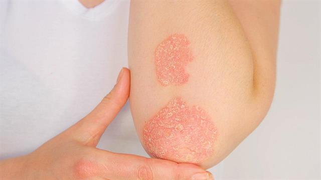 COVID-19 και ψωρίαση