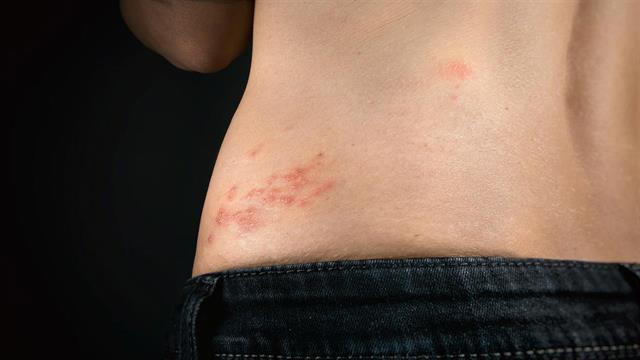 Έρπης ζωστήρας: Ευθύνεται και το στρες;