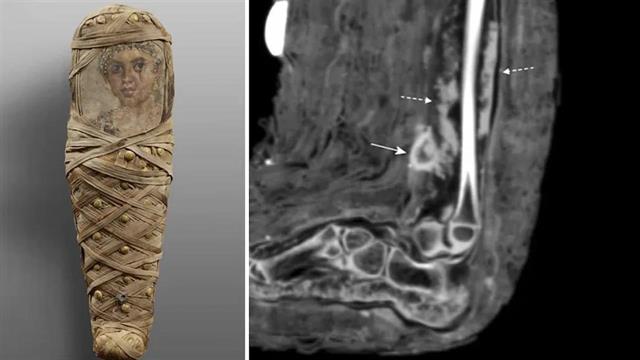 Βρέθηκε η πρώτη μούμια με δεμένη πληγή
