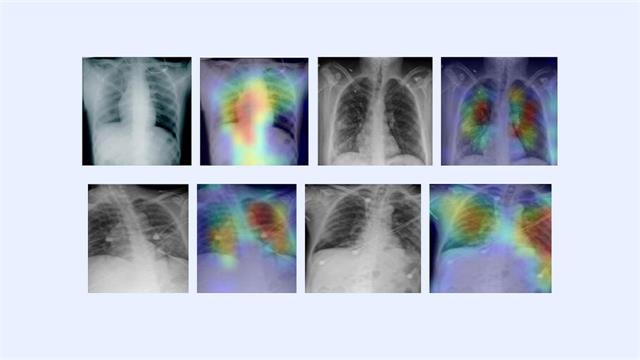 Καινοτόμα τεχνολογία τεχνητής νοημοσύνης μπορεί να διαγνώσει την COVID-19 σε λίγα λεπτά
