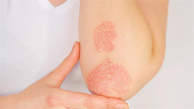 Ψωρίαση: Γιατί παρατηρείται έξαρση των συμπτωμάτων της τον χειμώνα
