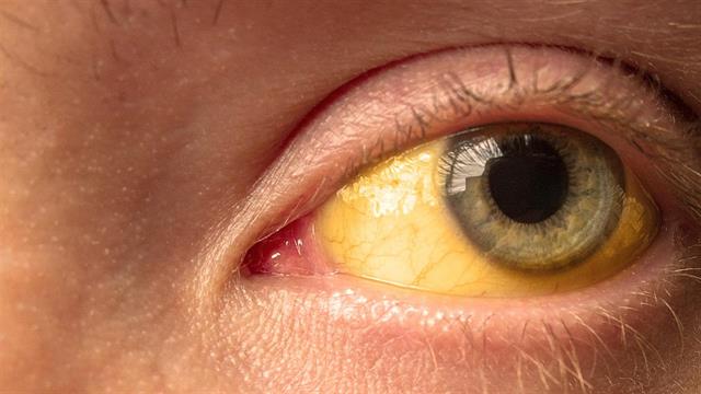 Τι μπορεί να συμβαίνει όταν αλλάζει χρώμα το άσπρο του ματιού