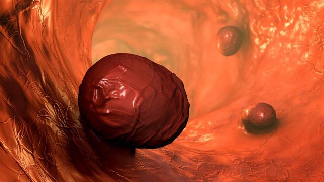 Η απώλεια βάρους συμβάλλει στη μείωση του κινδύνου ανάπτυξης πολυπόδων στο παχύ έντερο