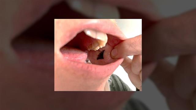 Αναπτύχθηκε επίθεμα ινσουλίνης που θα τοποθετείται στο εσωτερικό του μάγουλου