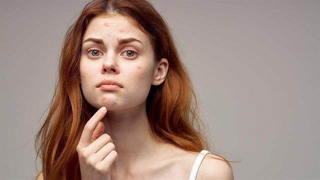 Εντοπίστηκαν 29 περιοχές του γονιδιώματος που επηρεάζουν την ακμή