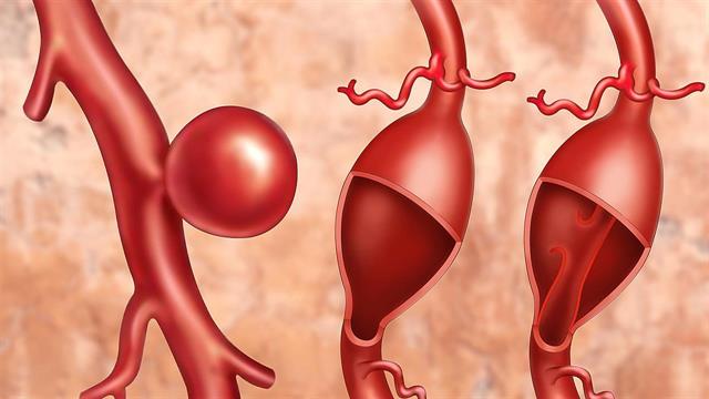 Διακαθετηριακή αντιμετώπιση ανευρυσμάτων