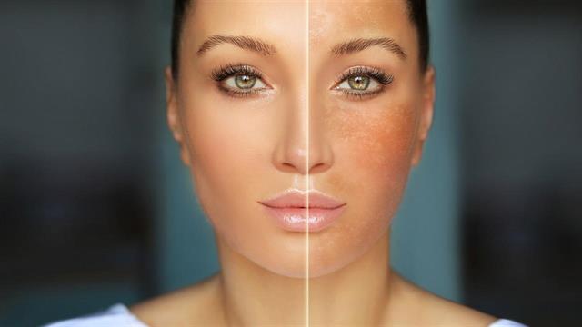 Microneedling: Θεραπεύει το μέλασμα;