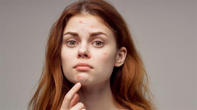 Ακμή: Μπορούν τα προβιοτικά να τη θεραπεύσουν;