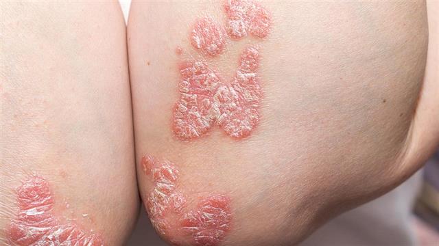 Ψωρίαση: Τι πρέπει να γνωρίζετε για την καλύτερη αντιμετώπισή της