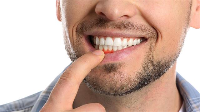 Περιοδοντίτιδα και στυτική δυσλειτουργία αυξάνουν τον κίνδυνο  καρδιαγγειακών συμβάντων