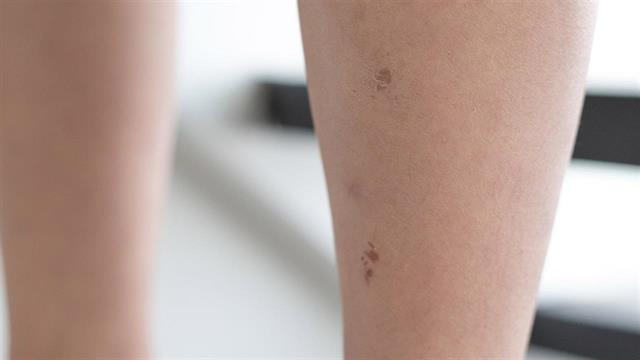 Ιπποκράτειο Θεσσαλονίκης: Επιτυχής η πρώτη εφαρμογή της καινοτόμου μεθόδου της ηλεκτροχημειοθεραπείας