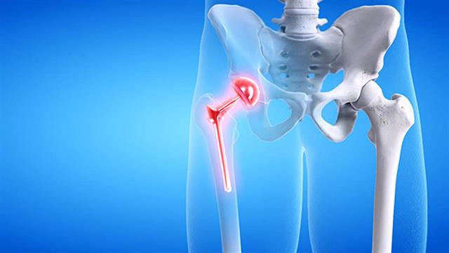 Αρθροπλαστική ισχίου: Όλα όσα πρέπει να γνωρίζετε για την επέμβαση