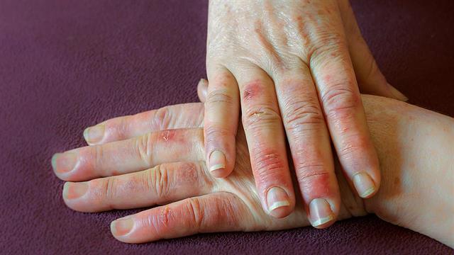 Κακή κυκλοφορία αίματος: Ποια είναι τα αίτια