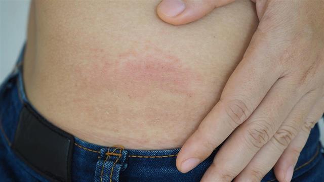 Η CoViD αυξάνει τον κίνδυνο για έρπητα ζωστήρα μετά την ηλικία των 50 ετών