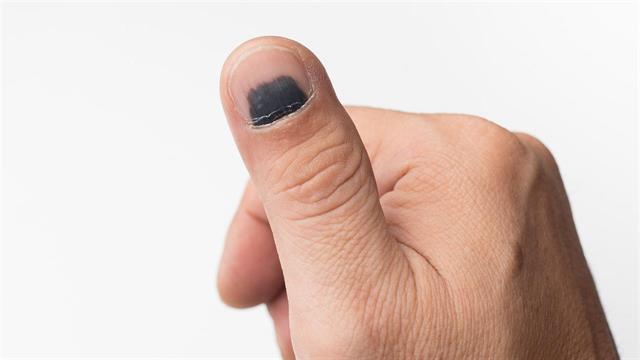 Γιατί χρειάζεται άμεση ιατρική φροντίδα το μελάνιασμα των νυχιών