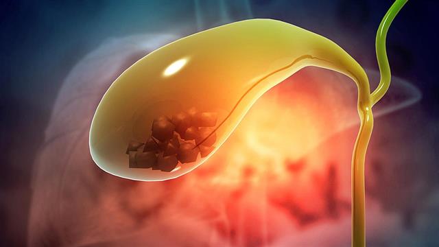 Συνδέεται η χολολιθίαση με τον καρκίνο στο πάγκρεας;