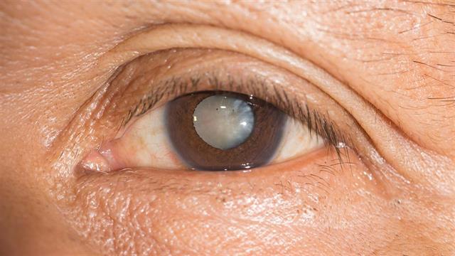 Πιο κοντά σε μια φαρμακευτική αγωγή κατά του καταρράκτη