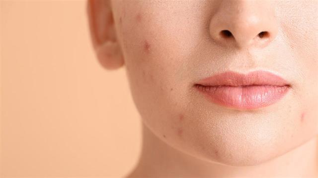 Ακμή ενηλίκων: Γιατί συμβαίνει και τι μπορώ να κάνω;