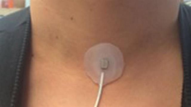 Επίθεμα τεχνητής νοημοσύνης στον λαιμό θα ειδοποιεί για έξαρση άσθματος και ΧΑΠ