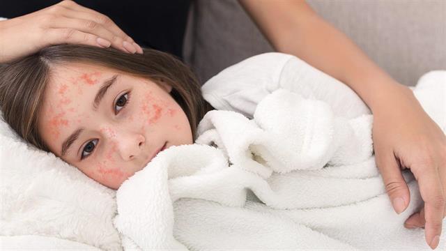 4.151 κρούσματα ιλαράς στην Ελλάδα το 2004-2021, 400.000 περιστατικά παγκοσμίως