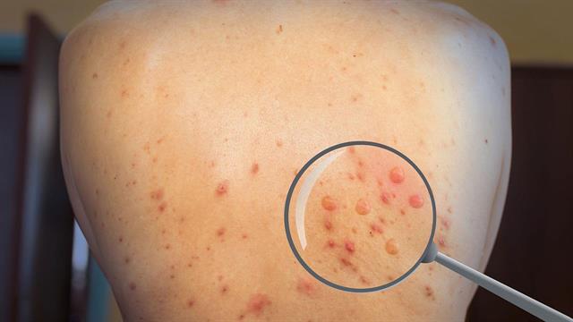 ΠΟΥ: Υπαρκτός ο κίνδυνος να καταστεί ενδημική η ευλογιά των πιθήκων