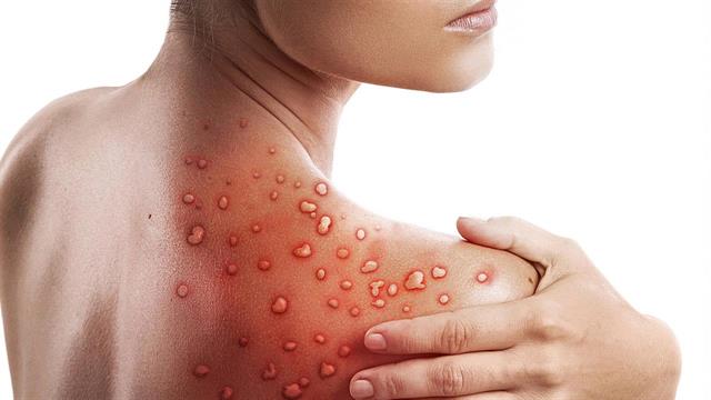 Είναι σεξουαλικά μεταδιδόμενη νόσος η ευλογιά των πιθήκων; -Την πιθανότητα εξετάζει ο ΠΟΥ