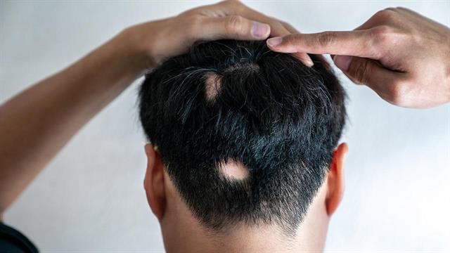 7 ερωτήσεις για την πιο σοβαρή αλωπεκία