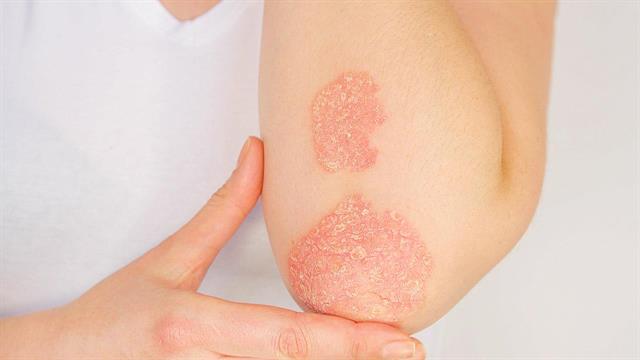 Ψωρίαση και διατροφή: Live διαδικτυακό σεμινάριο