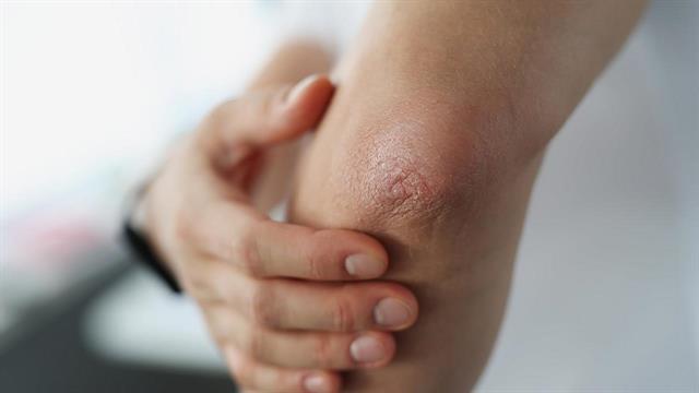 Ψωρίαση: Ποια είναι τα νέα δεδομένα στη θεραπεία