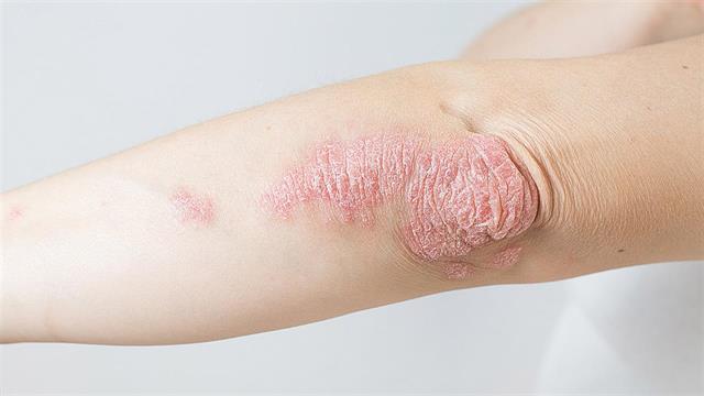 Αυξήθηκε η δαπάνη για το adalimumab- Στα 42,5 εκατ. ευρώ ανεβαίνει το 2023