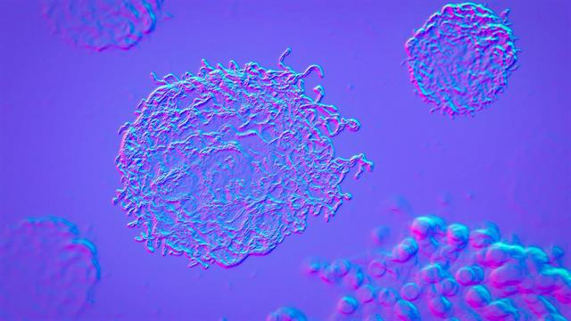 Επιδημιολόγοι προειδοποιούν για αύξηση του καρκίνου του παχέος εντέρου