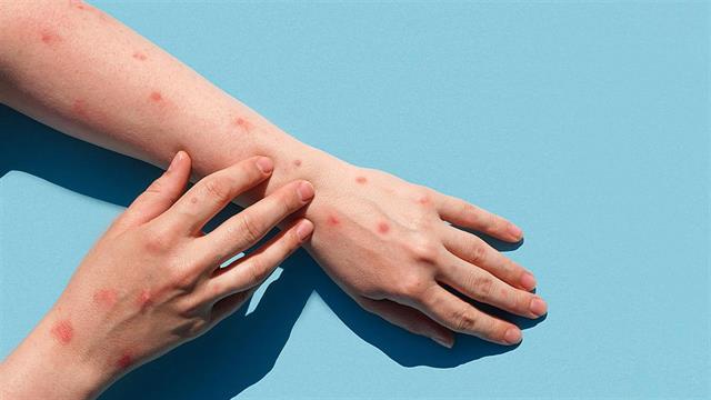 Ερευνα: Συμπτώματα που εμφάνισαν περιστατικά ευλογιάς των πιθήκων στο Λονδίνο