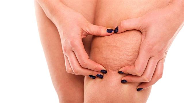 Χαλάρωση και κυτταρίτιδα: Αποτελεσματική αντιμετώπιση μετά τις διακοπές