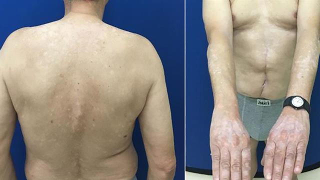 Ανδρέας Συγγρός: Περιστατικό λεύκης, μετά από εμβολιασμό κατά της CoViD με mRNA [μελέτη]