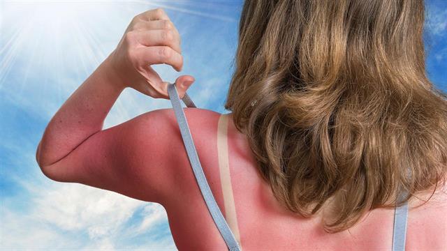 Πώς μπορούμε να αντιμετωπίσουμε τα ηλιακά εγκαύματα;