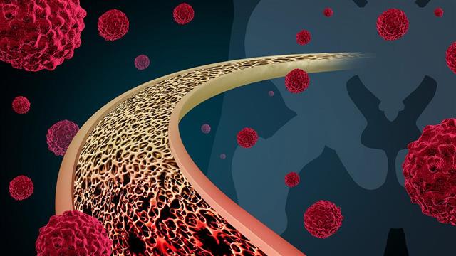 Η χρήση της θρομβοελαστομετρίας συμβάλλει στην κατανόηση της θρομβωτικής προδιάθεσης των ογκολογικών ασθενών