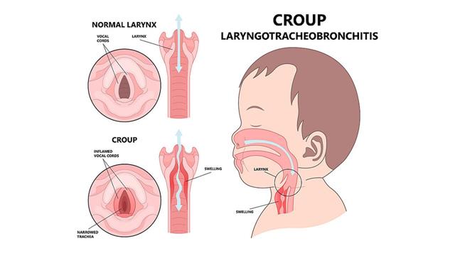 Ωμέγα-3 λιπαρά οξέα και βιταμίνη D κατά την εγκυμοσύνη προστατεύουν τα μωρά από ψευδοκρουπ