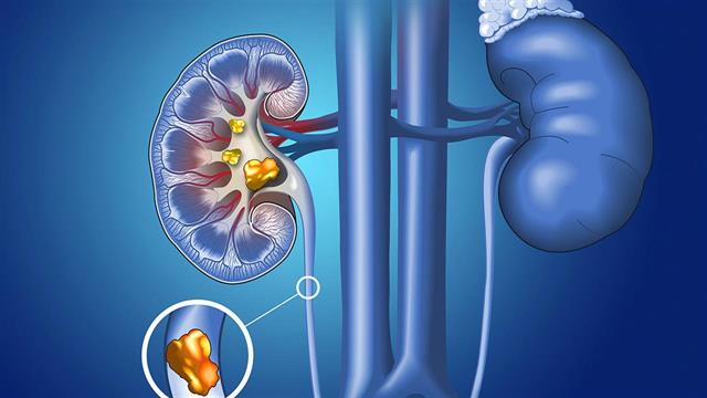 Η ακραία ζέστη αυξάνει τον κίνδυνο νεφρολιθίασης