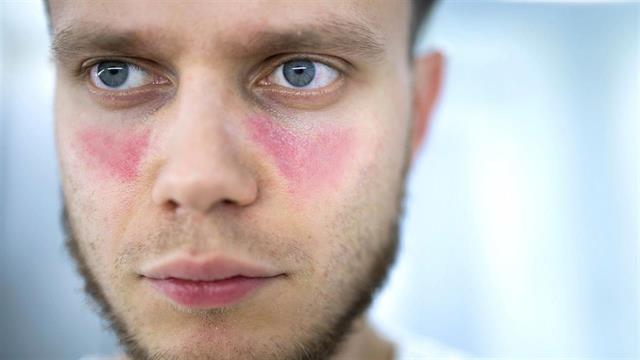 Σε μικρή έρευνα θεραπεία CAR-T οδήγησε σε ύφεση τον ερυθηματώδη λύκο