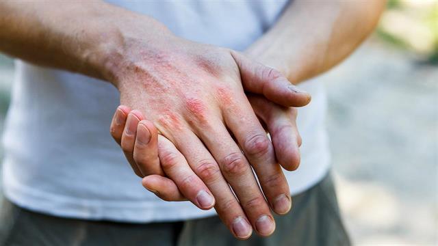 ‘’Επιδέρμια’’: Η Ατοπική Δερματίτιδα είναι ένα νόσημα που επηρεάζει την ποιότητα ζωής  των ασθενών