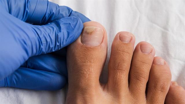 Αποχρωματισμένα και λευκά νύχια ποδιών: Τι σημαίνουν